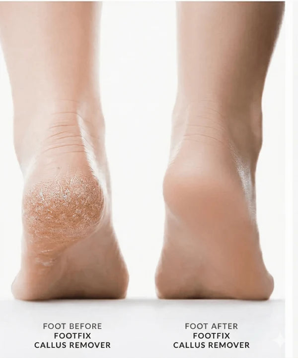 Callus Remover